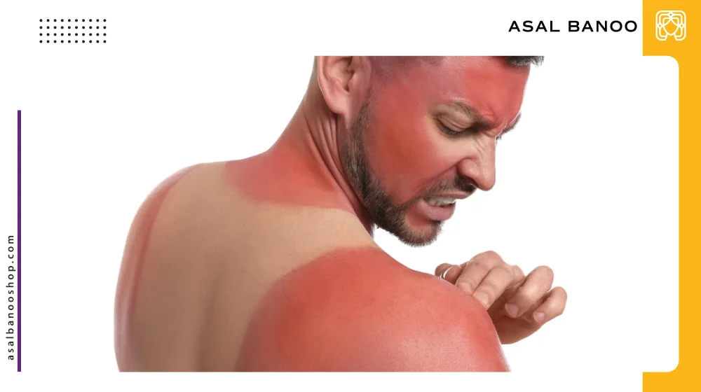روش های درمان سریع پوست آفتاب سوخته